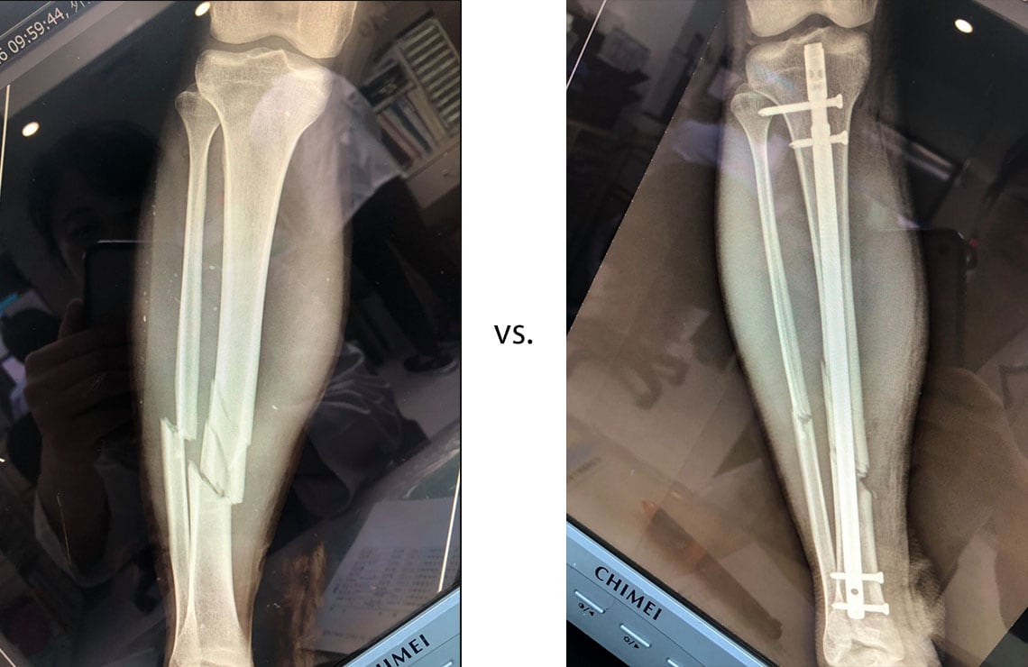 獨木舟翻覆小腿骨折 髓內釘手術固定治療 骨折開刀手術患者分享心得 永和骨科陳奕霖醫師