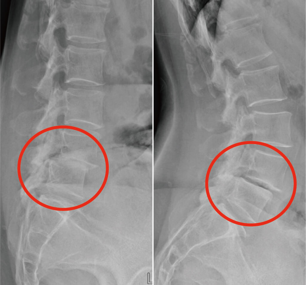 脊椎滑脫是什麼 詳解椎弓斷裂 腰椎椎間盤滑脫症狀和手術治療方式