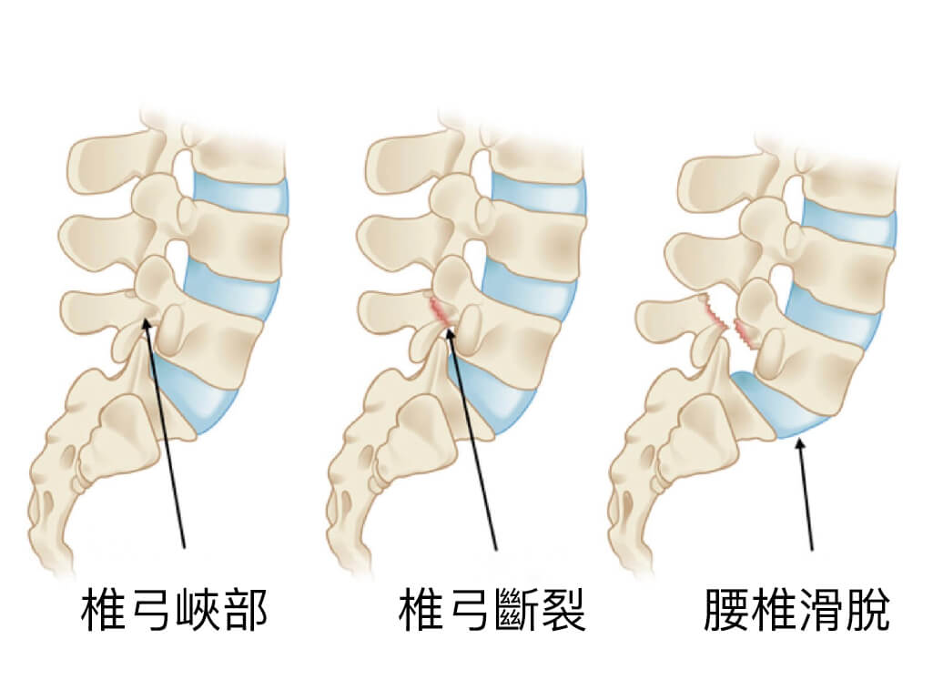 尾 椎 滑 脫