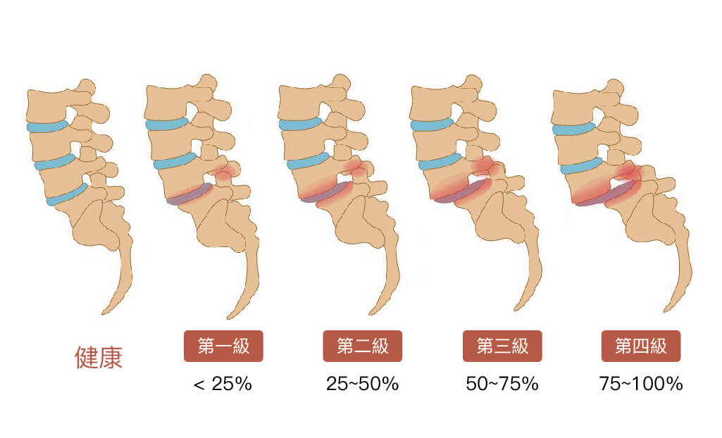 脊椎滑脫是什麼 詳解椎弓斷裂 腰椎椎間盤滑脫症狀和手術治療方式