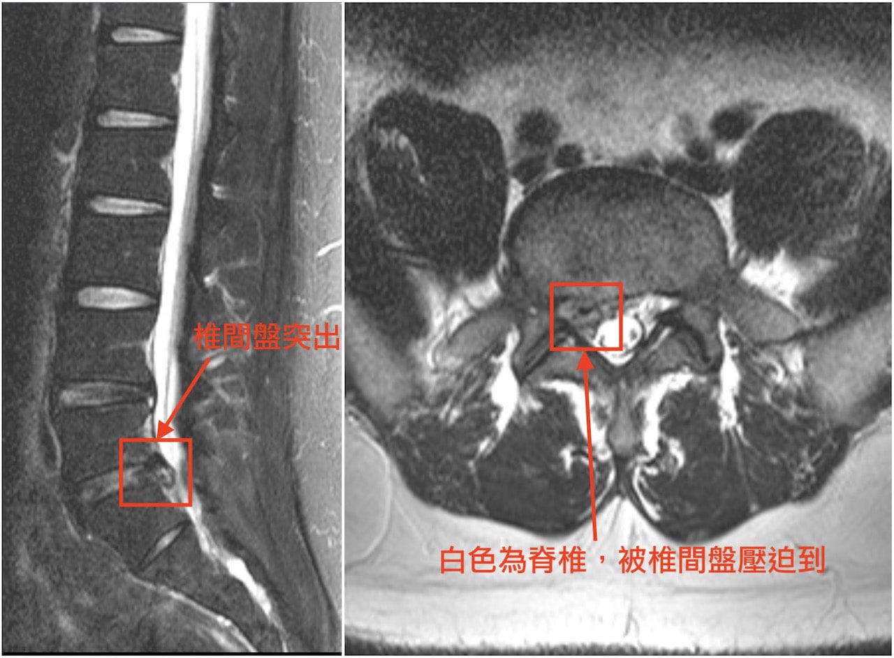 第十三集 腰椎側彎椎間盤突出神經壓迫需開刀 三個案例 Youtube