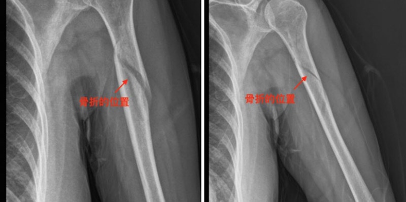 肱骨骨折透過骨髓內釘微創手術 比傳統打鋼板傷口更小 骨折癒合速度也更快