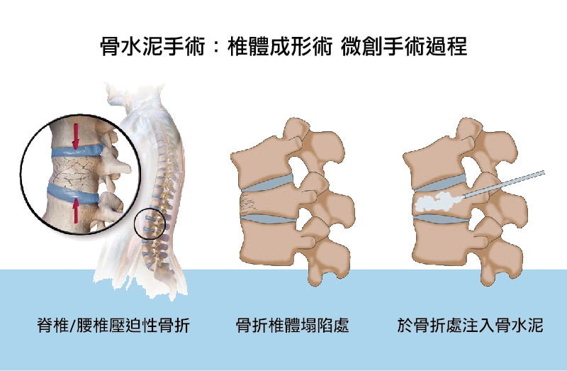 骨水泥是什麼 骨水泥自費或健保給付的優缺點為何 一次搞懂骨水泥